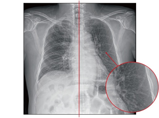 Smart Bone Suppression
