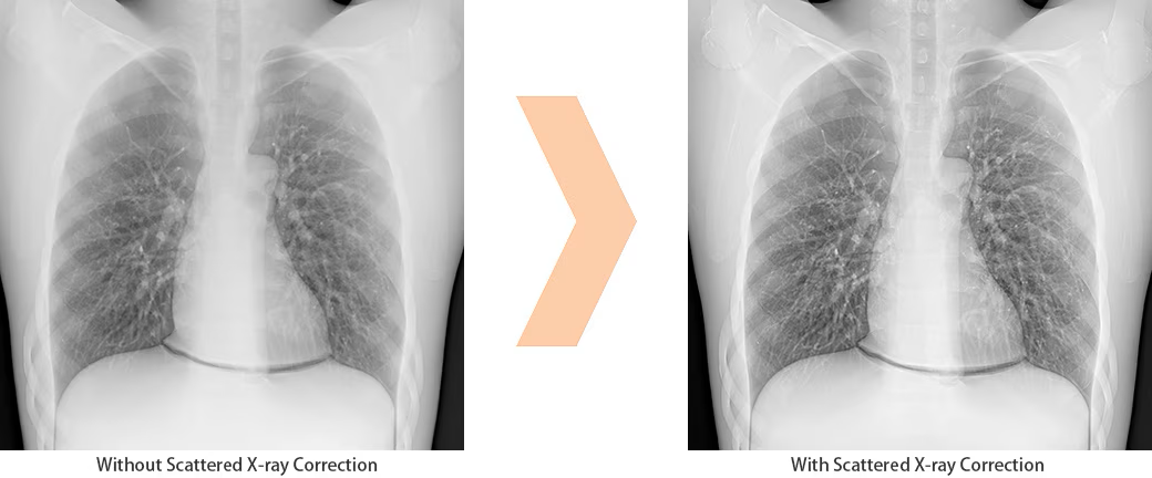 Scatter Correction Enables Grid-less Radiography